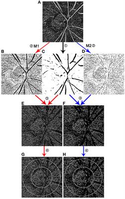 Performance Assessment of Two Different Approaches of Measuring Skeletonized Radial Peripapillary Capillary Vessel Density in Glaucoma Patients